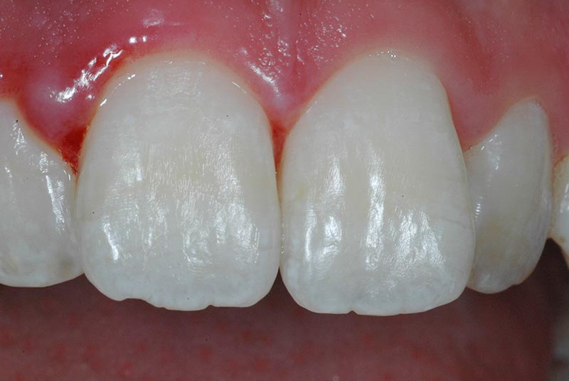 Verfärbt sich grau kind zahn grauer Zahn